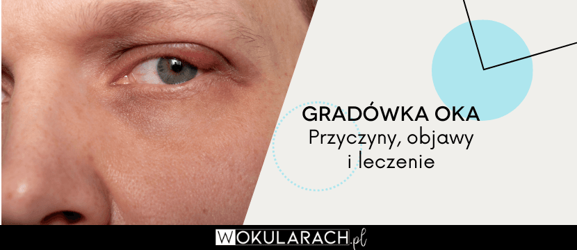 Co to jest gradówka oka? Przyczyny, objawy i leczenie